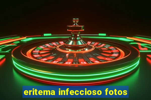 eritema infeccioso fotos